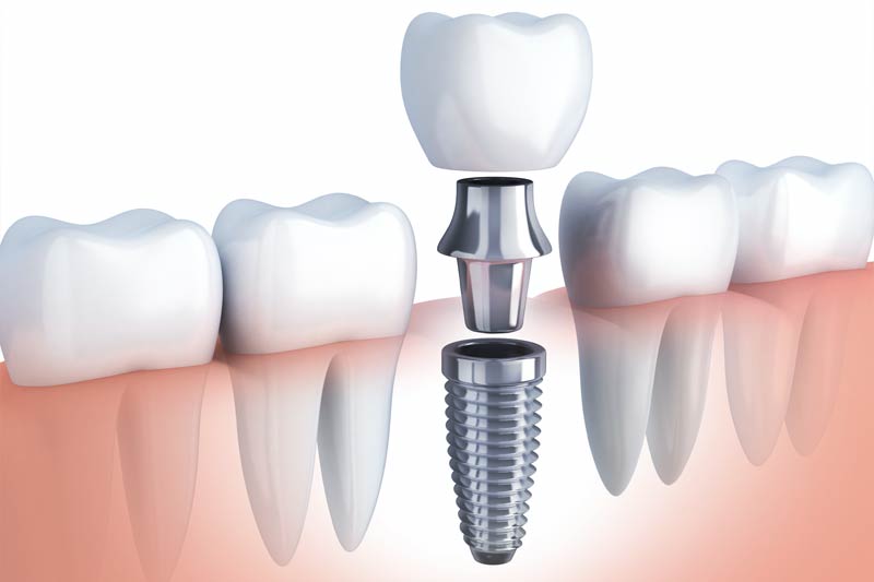 Implant Dentist in Ridgefield