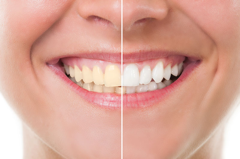 Teeth Whitening in Ridgefield